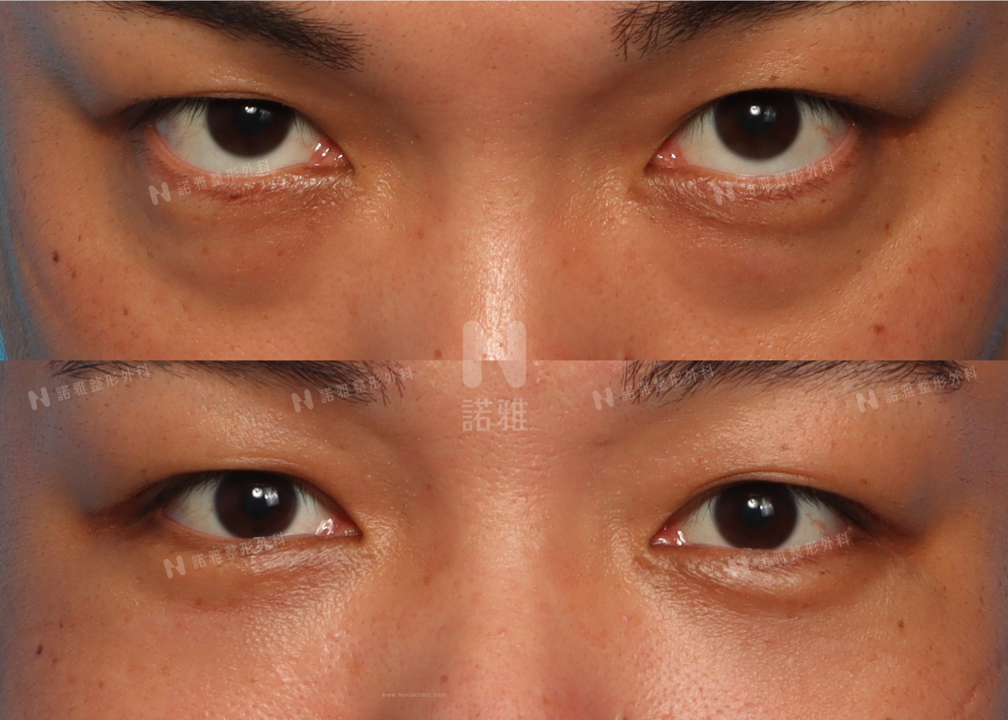 眼袋手術案例