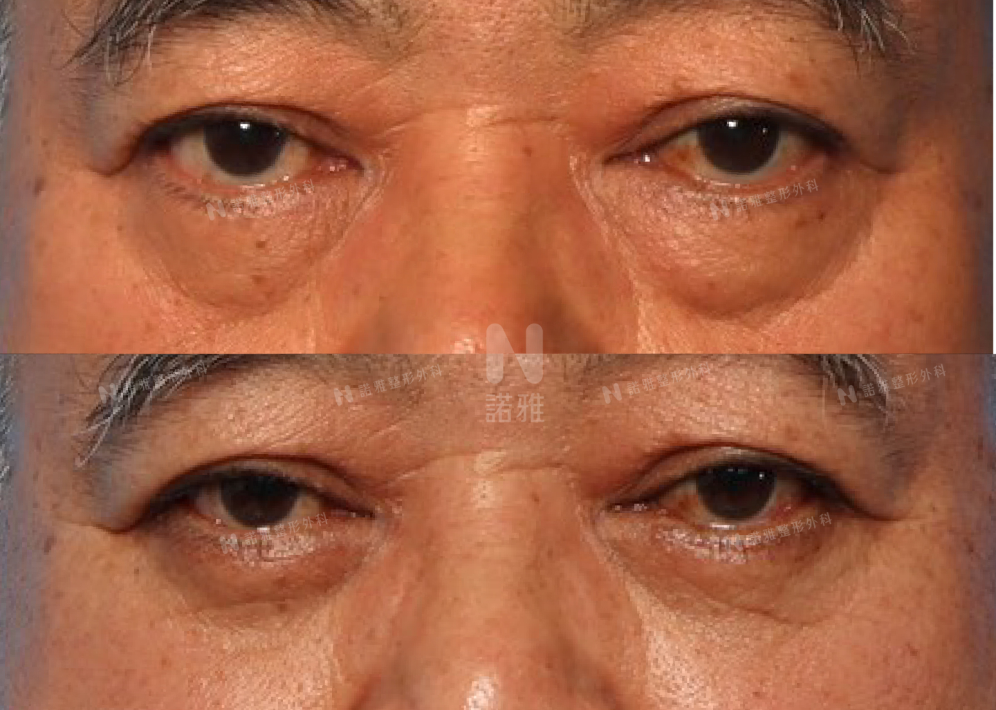 眼袋手術案例