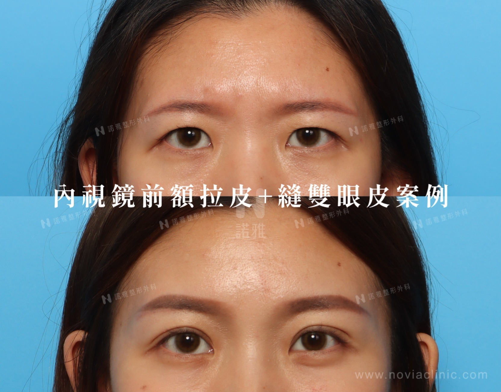前額拉皮+縫雙眼皮