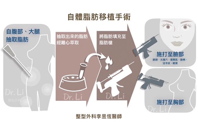 自體脂肪移植手術流程