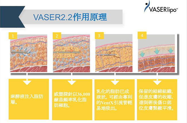 Vaser2.2威塑抽脂作用原理