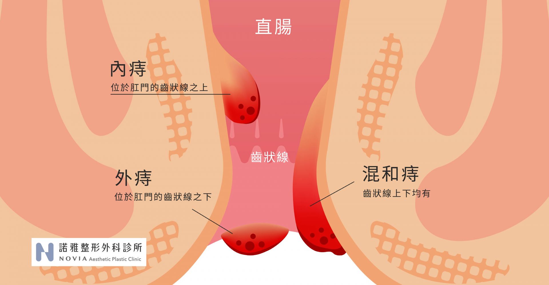 內痔外痔與混和痔的圖解