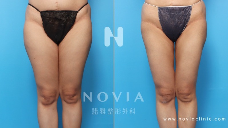 諾雅整形外科－威塑抽脂手術，腿部抽脂手術案例前後對比圖。