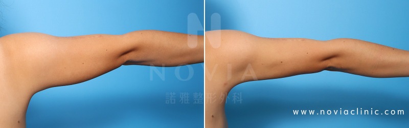 諾雅整形外科－威塑抽脂手術，蝴蝶袖手部抽脂手術案例前後對比圖。