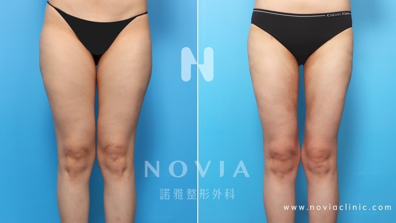 諾雅整形外科－威塑抽脂手術，腿部抽脂手術案例前後對比圖。
