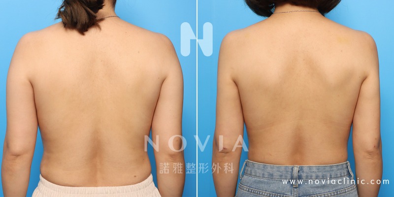 諾雅整形外科－威塑抽脂手術，背部抽脂手術案例前後對比圖。