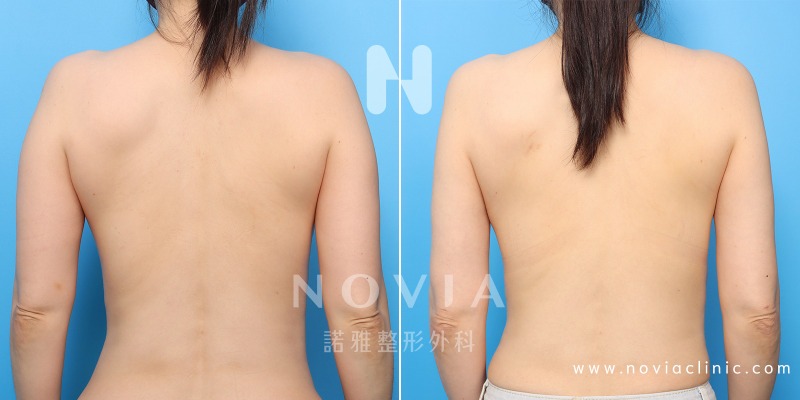 諾雅整形外科－威塑抽脂手術，背部抽脂手術案例前後對比圖。