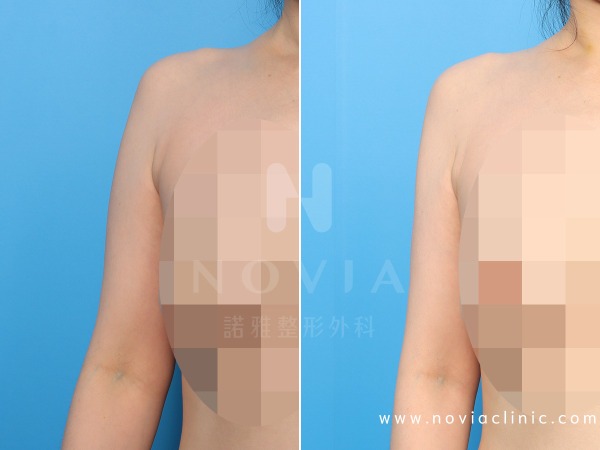 諾雅整形外科－威塑抽脂手術，手臂抽脂手術案例前後對比圖。