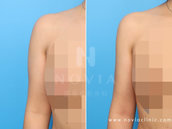 諾雅整形外科－威塑抽脂手術，手臂抽脂手術案例前後對比圖。