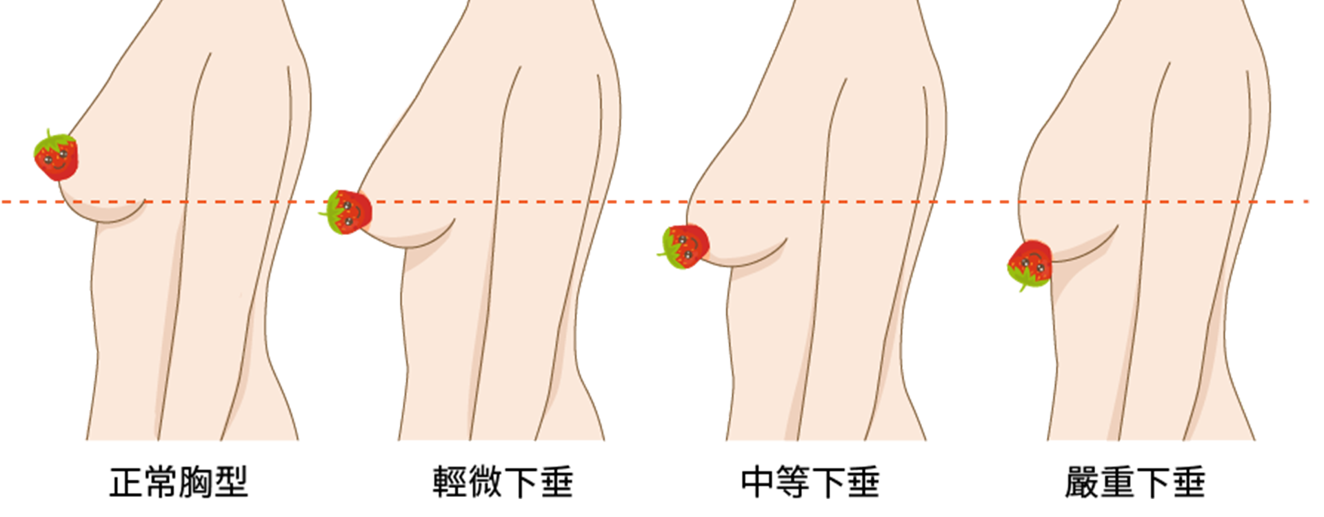 胸部下垂