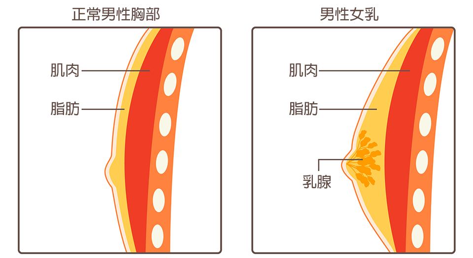 男性女乳症評估重點：正常男性胸部與男性女乳的肌肉、脂肪與乳腺分佈。