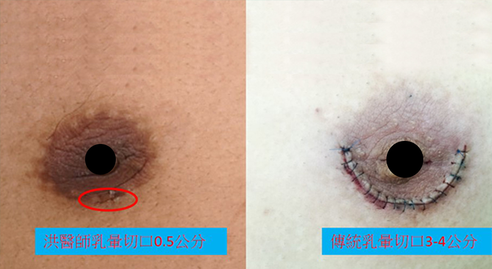 超微創複合式男性女乳手術 實際案例圖片－諾雅專業乳房手術