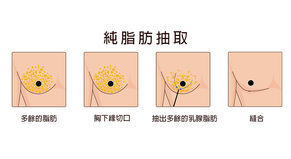 男性女乳手術種類：純抽脂抽取－諾雅整形外科