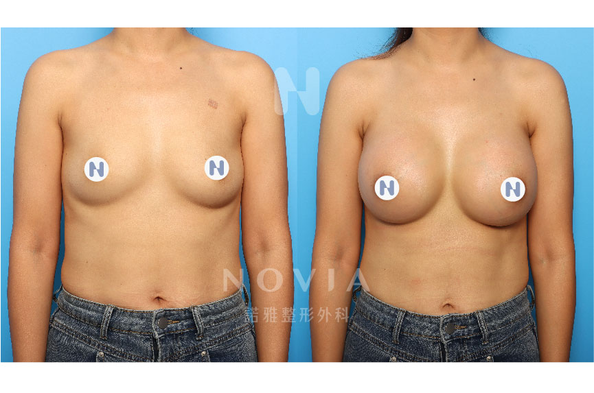 諾雅隆乳手術｜美麗見證案例，果凍矽膠隆乳手術前後對比照片