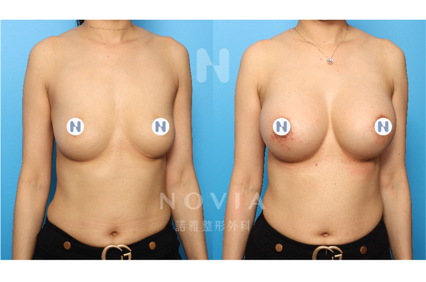 諾雅隆乳手術｜美麗見證案例，果凍矽膠隆乳手術前後對比照片