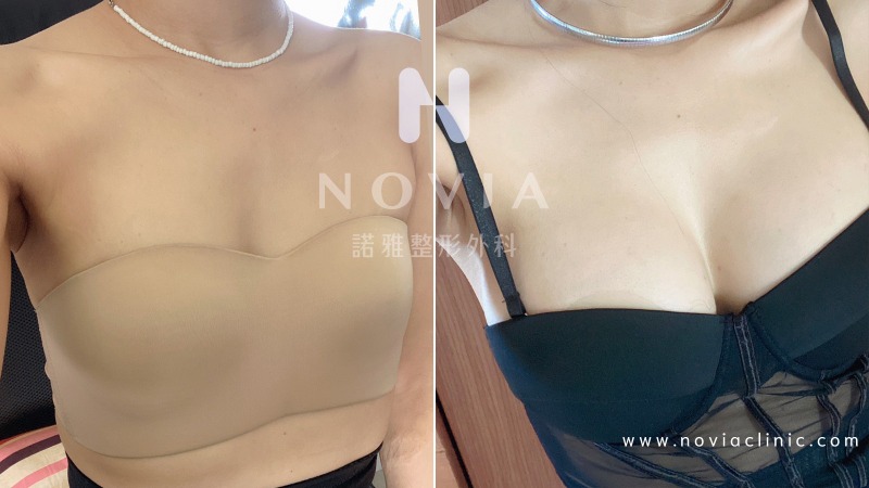 諾雅Sebbin柔滴隆乳柔滴隆乳術後3個月