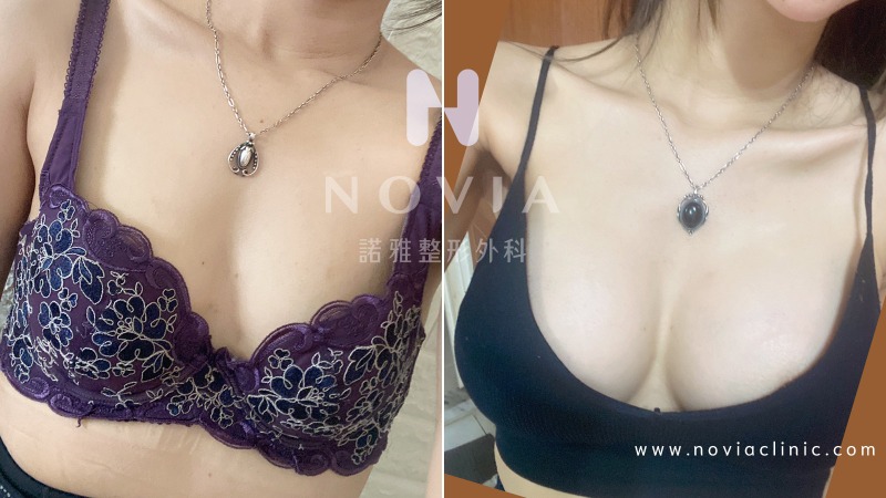 諾雅Sebbin柔滴隆乳柔滴隆乳術後3個月