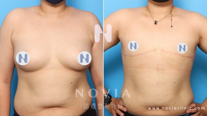 一字型平胸手術案例