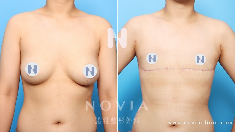 一字型平胸手術案例
