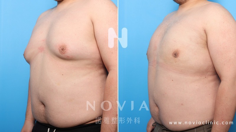 男性女乳案例 什麼是男性女乳症？