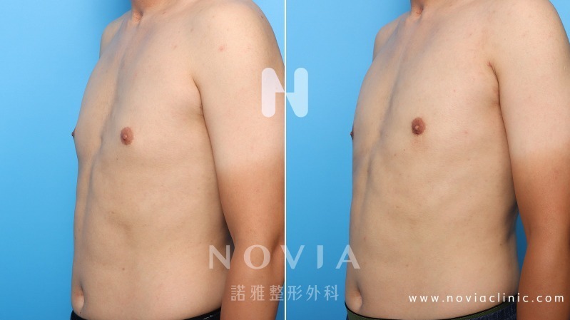 男性女乳手術案例 男性女乳症手術注意事項