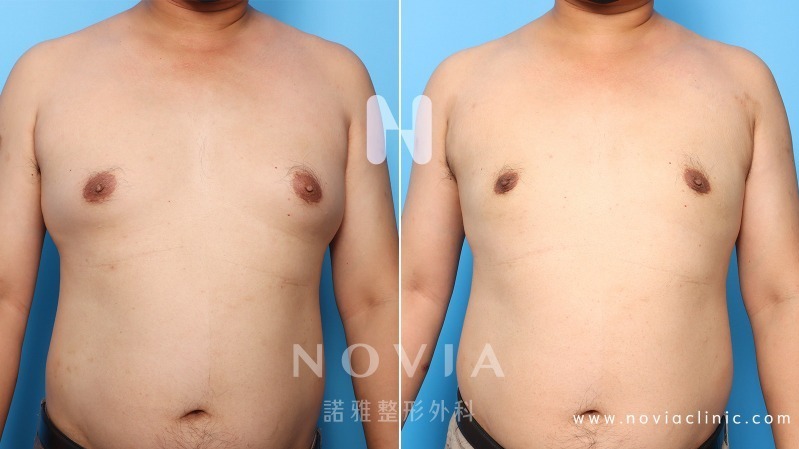 諾雅整形外科：男性女乳症手術推薦