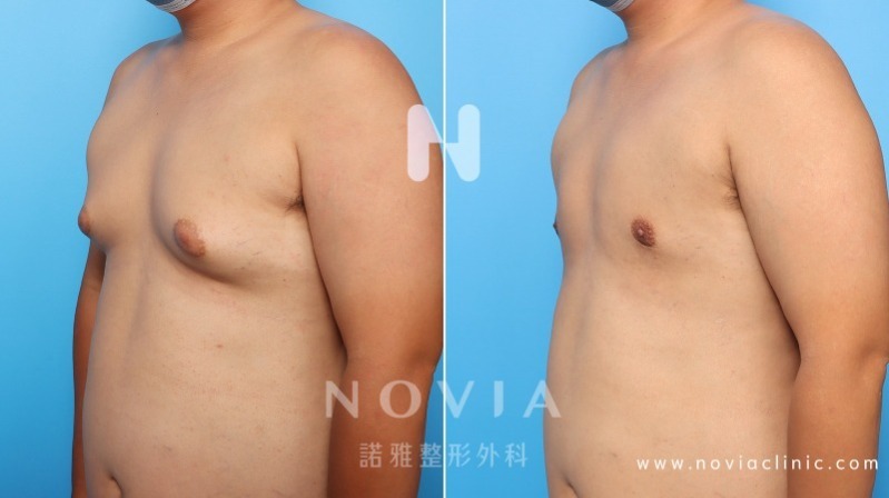 專業男性女乳症手術 男性女乳症手術Gynecomestia(Male Breast Reduction )