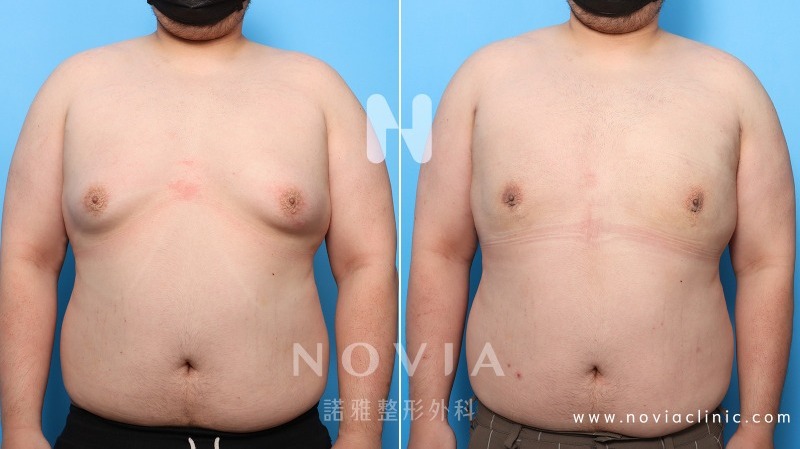 男性女乳症案例 淺談男性女乳症