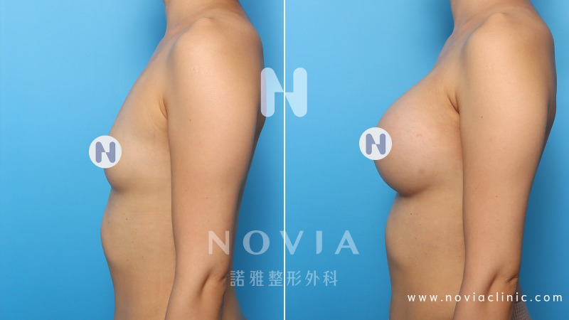 諾雅隆乳手術推薦，隆乳手術案例對比圖