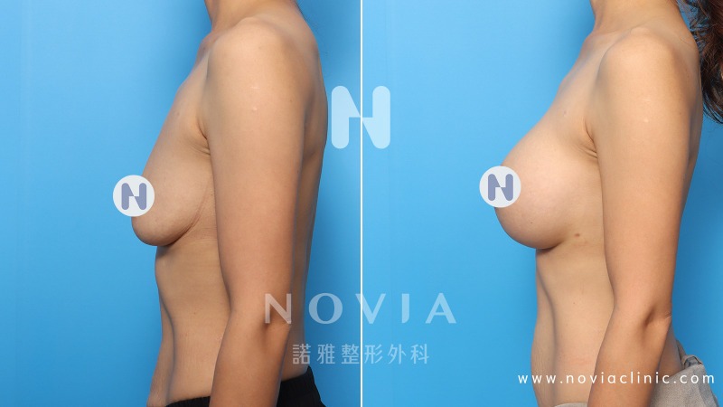 諾雅隆乳手術｜隆乳材質比較，果凍矽膠隆乳手術，成功案例前後對比照片。