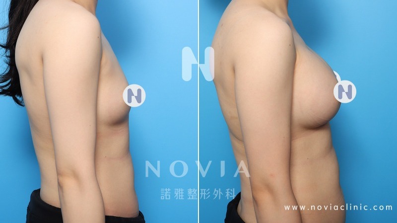 諾雅隆乳手術｜美麗見證案例，手術前後對比照。