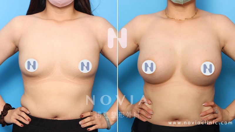 諾雅隆乳手術｜美麗見證案例，果凍矽膠隆乳手術前後對比照片。