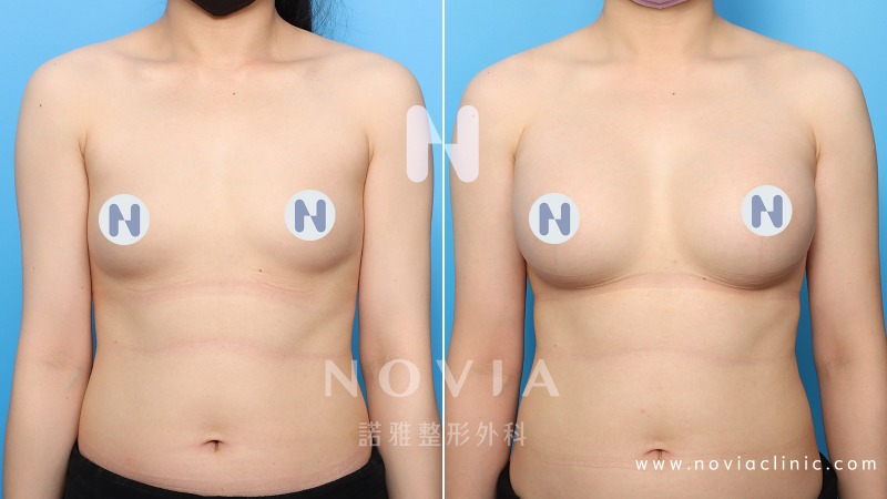 諾雅隆乳手術｜美麗見證案例，手術前後對比照。