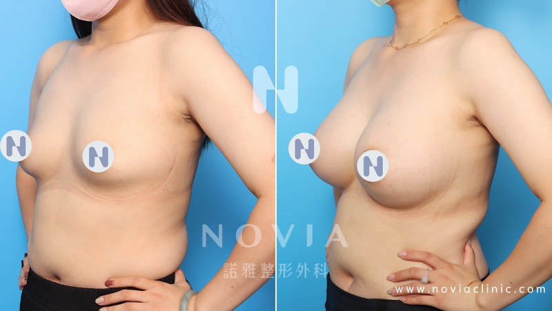 諾雅隆乳手術｜隆乳的優點，內視鏡隆乳手術前後對比照。