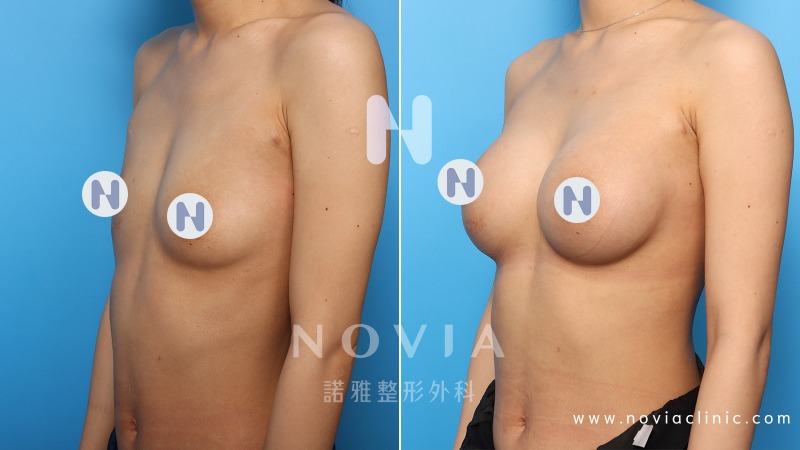 諾雅專業整形外科｜美麗見證案例，果凍矽膠隆乳手術前後對比照片。