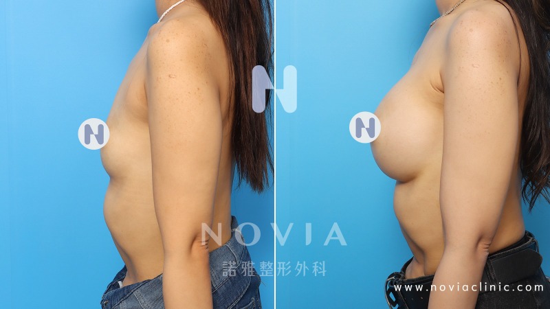 諾雅專業整形外科｜美麗見證案例，果凍矽膠隆乳手術前後對比照片。