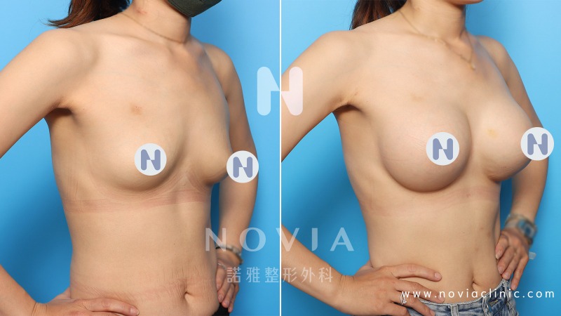 諾雅Sebbin柔滴隆乳案例，隆乳手術前後對照圖