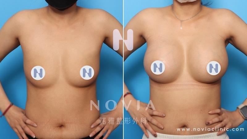 諾雅隆乳手術推薦，隆乳手術案例對比圖