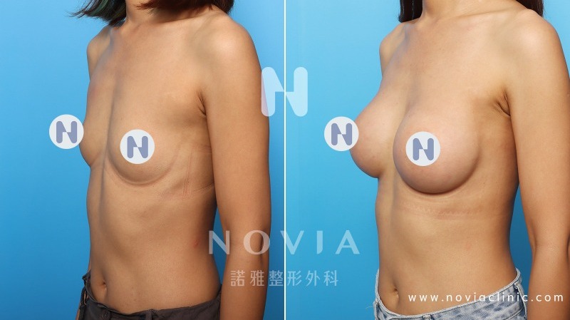 諾雅隆乳手術｜隆乳原理介紹，內視鏡隆乳案例，手術前後對比照。