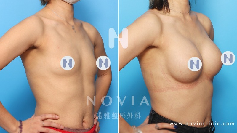 諾雅隆乳手術｜美麗見證案例，Sebbin 香榭柔滴隆乳手術，手術前後對比圖