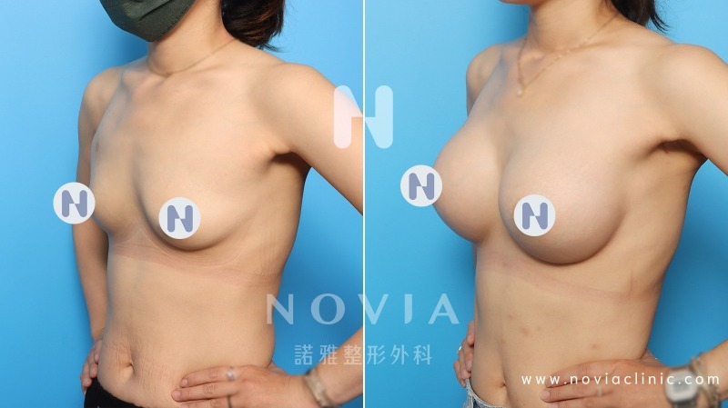諾雅隆乳手術｜隆乳材質比較，果凍矽膠隆乳手術，成功案例前後對比照片。
