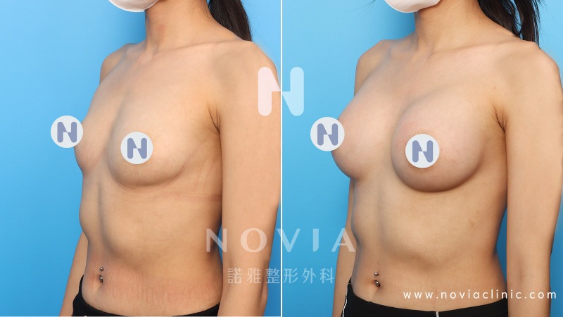 Motiva魔滴隆乳手術，隆乳案例前後對比圖