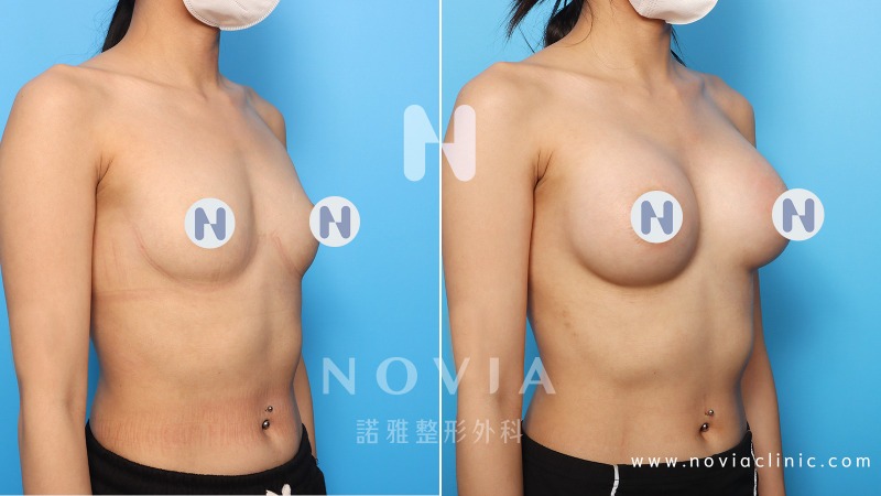諾雅隆乳手術｜隆乳原理介紹，內視鏡隆乳案例，手術前後對比照。