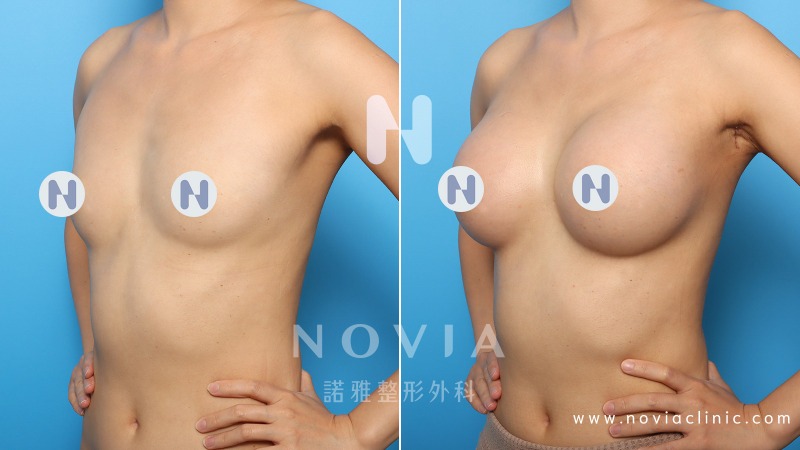 隆乳植入物隆乳案例圖