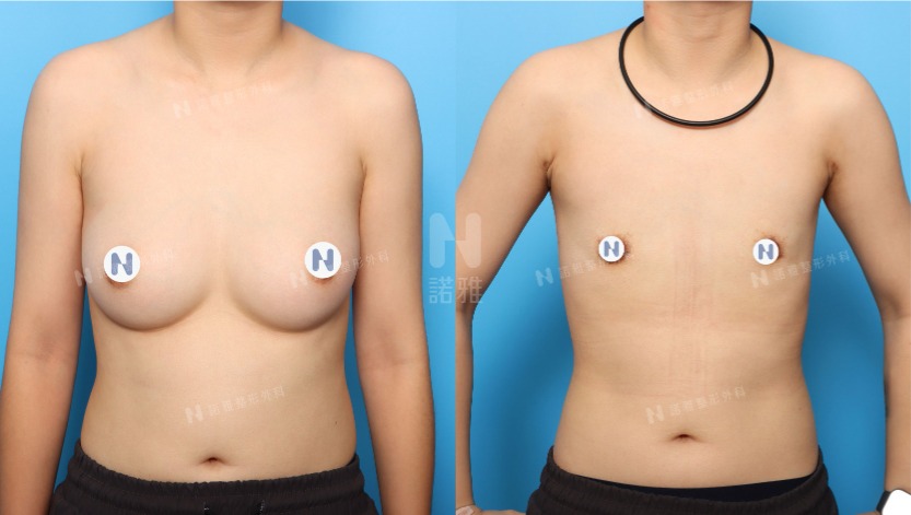 微創平胸手術案例