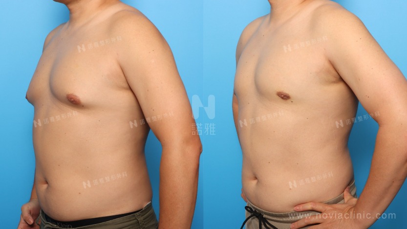 男性女乳症是什麼？自我檢測、改善方式帶你一次看懂