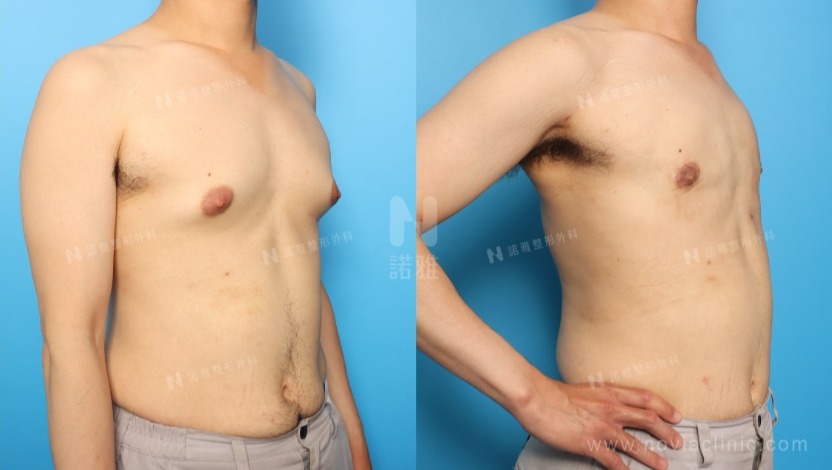 男性女乳症的診斷與手術指南