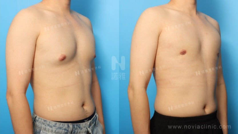 男性女乳症手術推薦