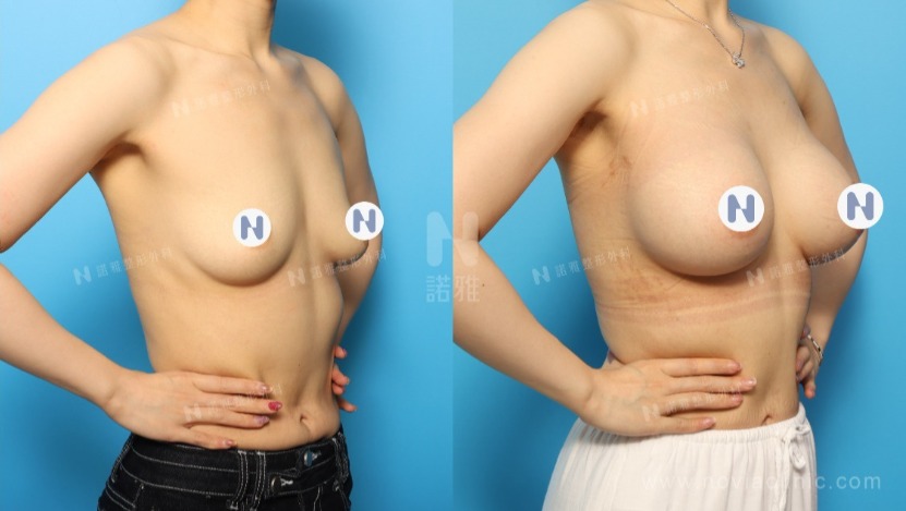 諾雅魔滴隆乳手術美麗見證案例