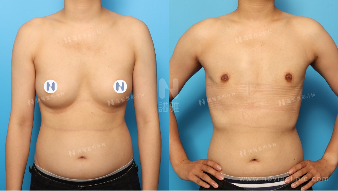 微創平胸手術案例